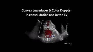 〖Ultrasound〗 Color doppler for heart & lungs 🫀🫁