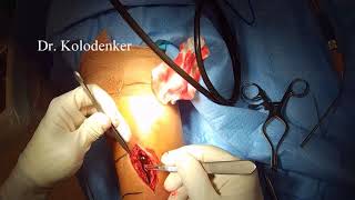 Distal Tibia Brodie's Abscess Surgical Treatment