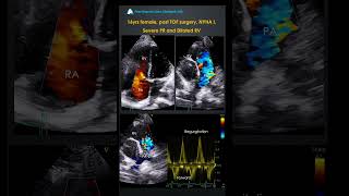 #shorts Post TOF Surgery Pulmonary Regurgitation