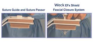 Weck EFx Shield Fascial Closure System