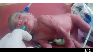 new born female came in a very serious condition baby hold their own breath baby is so small😢