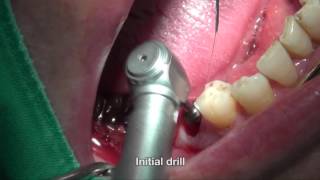 Mandibular Premolar Immediate implant placement and loading using INNO and Teflon sheet