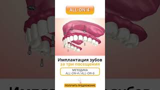 Имплантация зубов All-on-4