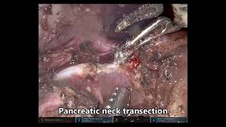 Robotic fluorescence-guided bile duct preserving pancreatic head resection with splanchnic...