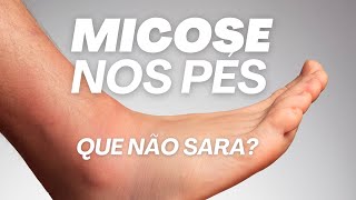 Micose nos pés que não sara? Por Dr. Luiz Gameiro, dermatologista