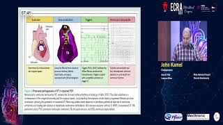 VT Ablation in fallot teralogy   Dr  John Kamel