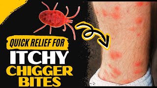 How to Treat Chigger Bites At Home?