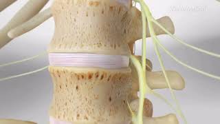 Lumbar Disc Herniation