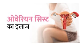 Ovary cyst symptoms & Treatment