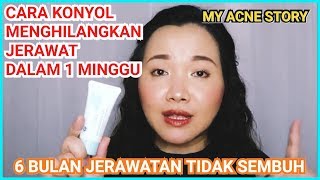 Cara Menghilangkan Jerawat Dalam Satu Minggu Dan Ninggalin Bekasnya | YMARY MY |