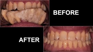 Dental Implant