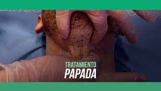 Tratamiento PAPADA