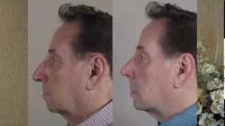 Rhinoplasty Patient of Dr. Parker Tells His Story