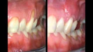 Treatment for Receding Gums