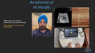 The Basics of M Mode Ultrasound for Fetal Heart Assessment | Part 2