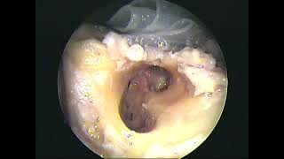 Temporal bone dissection endoscopic two handed part 3(unedited)-dr.shreekantha acharya