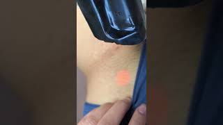 Laser hair removal on bikini line of an Asian woman