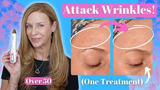 Real Results! Wrinkle Reduction Using the Snow Fibroblast Plasma Pen | Pros & Cons | Before & After