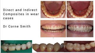 Indirect and direct composite restorations in wear cases with Dr Corné Smith