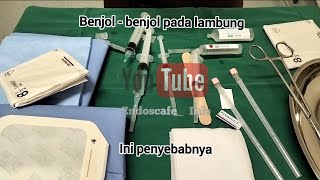 P0lip pada lambung, Penyebab serta bagaimana mengatasinya