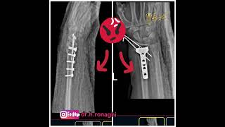 نتیجه عالی عمل شکستگی مچ دست دکتر حسین رونقی متخصص جراح ارتوپد #متخصص_جراحی_ارتوپدی #پزشک