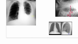 Dressler Syndrome (Post Cardiac Injury Syndrome)