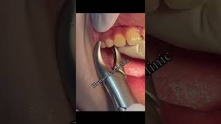 Baby teeth Extraction