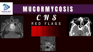 Mucormycosis CNS complications simplified#Guitar pick sign#Black turbinate sign#Umamaheshwar Reddy.V