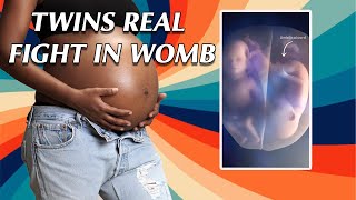 AMAZING! Twins Real Fight Inside the Mother's Womb