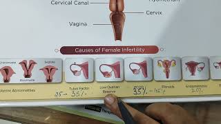 COMMON CAUSES OF FEMALE INFERTILITY