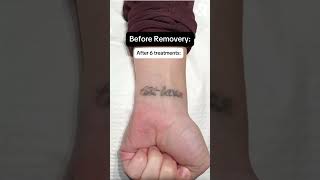 Before & After Tattoo Removal at Removery😍