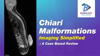 Chiari Malformations imaging simplified: Case Based Review #Cases of Chiari -1, 1.5, 2, 3 explained#