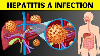 Hepatitis A Infection - Signs & Symptoms, Risk Factors, Virology, Diagnosis, And Treatment