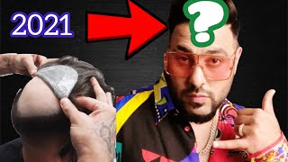 BADSHAH LATEST|Hair Transplant| Hair patch| minoxidil|finasteride| results|wig|hindi|hairstyle