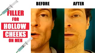 Dermal Filler Rejuvenation:  Men - Replace Lost Cheek Volume.