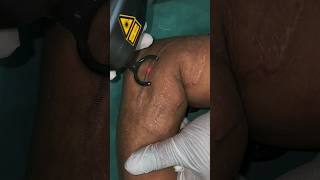 Treatment of Scar Developed After Skin Grafting #skintreatment #shorts #skinburn #dermatologist