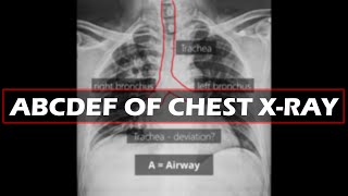 How to read a Chest X ray | ABCDEF of CXR