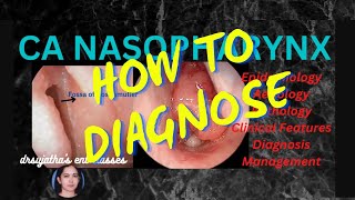 200.Nasopharyngeal Carcinoma Part2/3  #Diagnosis of Nasopharyngeal Carcinoma #clinicalexamination