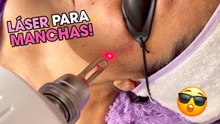 Tratamiento de MANCHAS con LÁSER YAG!! 😱