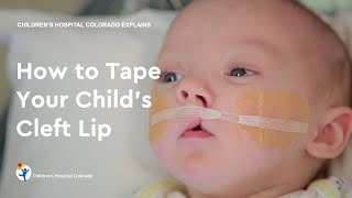 How to Tape Your Child’s Cleft Lip