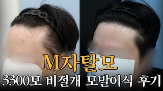 [Mobien TV] 30대 남성 M자 모발이식 비절개 3300모 1년 경과 #광주탈모치료 #전남모발이식