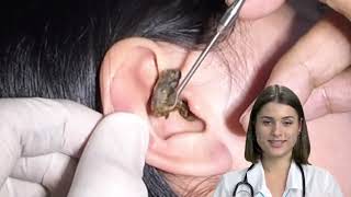 Dr.Natacha, earwax removal, causes, symptoms, traitement.