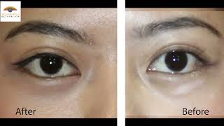 Rejuvenation of under eye bags and  prominent Tear trough