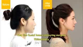 V Line Surgery In Korea - Jaw reduction at JW Plastic Surgery in Seoul, South Korea