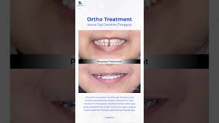 Gigi Kamu Overbite (Tonggos) ❓🤔 #doktergigisurabaya #9corthodontics #braces #gigitonggos #behelgigi