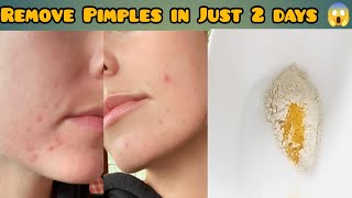 How to remove PIMPLES 💗 || PIMPLES को जड़ से खत्म करें और पाए बेदाग़ Spotless Skin - YouTube