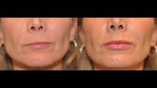 Dr. Dean Kane Has Natural Looking Solutions for Common Lip Concerns