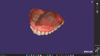 * IDDA MiniBytes - How to design a PARTIAL Denture with IMMEDIATE COPY on EXOCAD *