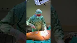 Tummy Tuck Liposuctıon Breast Lift Rhinoplasty Bbl