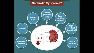 Nephrotic Syndrome